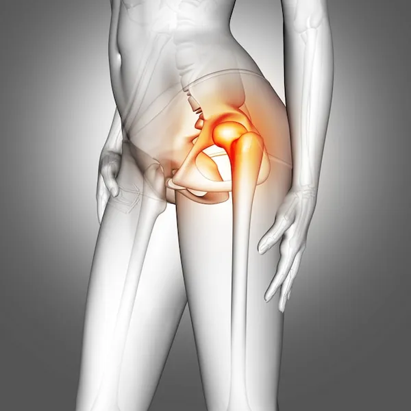 bursitis de cadera, causas y manejo efectivo