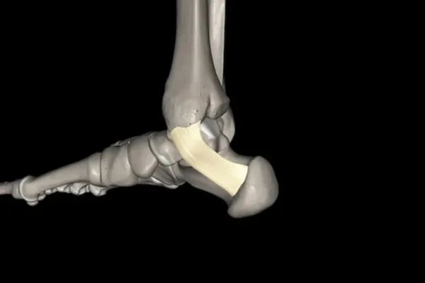 fractura del tendon de aquiles