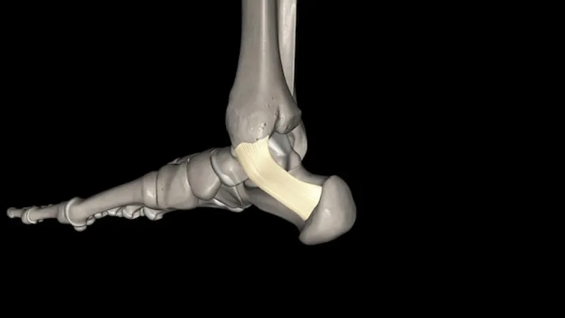 fractura del tendon de aquiles