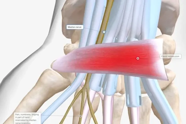 tendinitis calcificante en la insercion del tendon