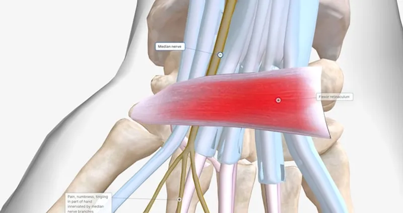 tendinitis calcificante en la insercion del tendon