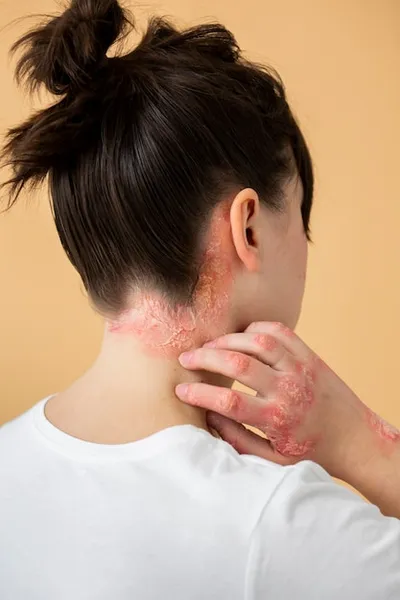 dermatitis en la dermis