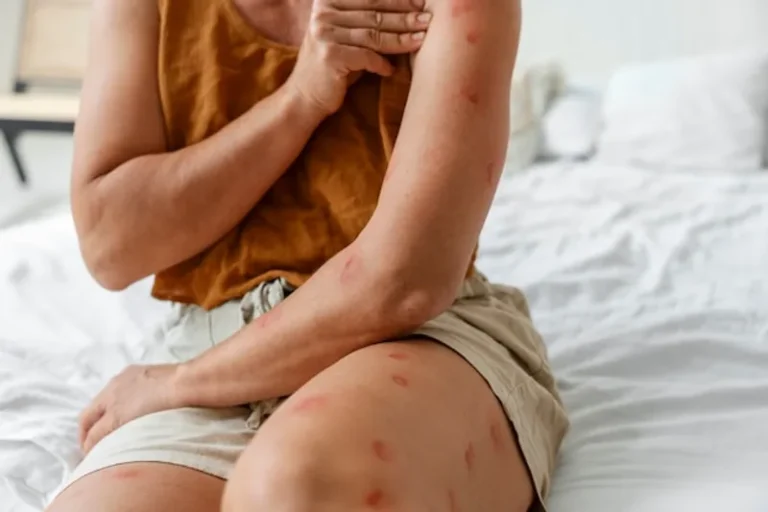 Dermatitis seborreica en la dermis: entendiendo sus causas y síntomas