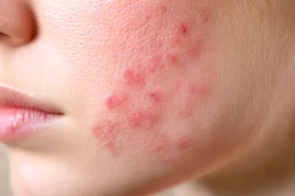 rosacea en la dermis