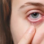 conjuntivitis bacteriana