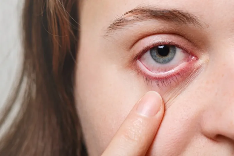 conjuntivitis bacteriana