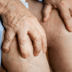 Artritis reumatoide en miami