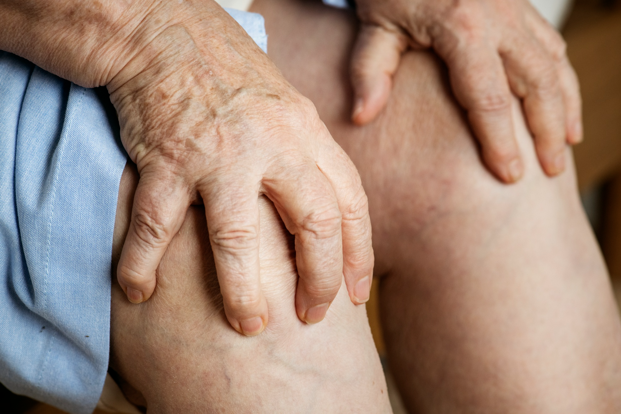 Artritis reumatoide en miami